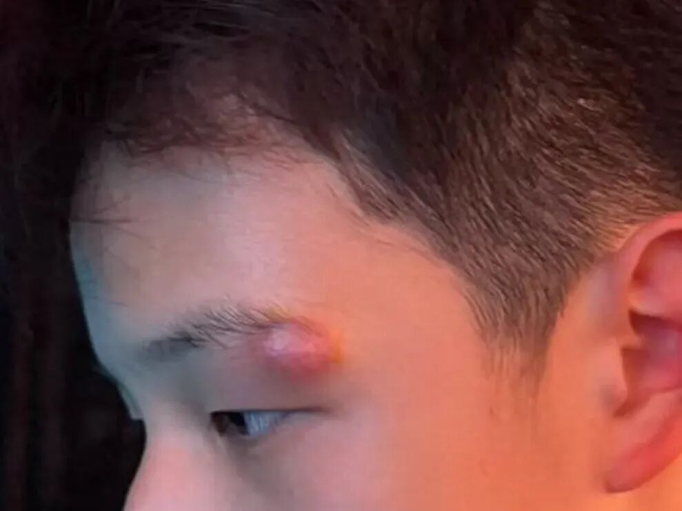 女明星为孩子挤痘致其脸缝四针！火疖子≠痘痘，学会正确分辨和处理，避免感染加重