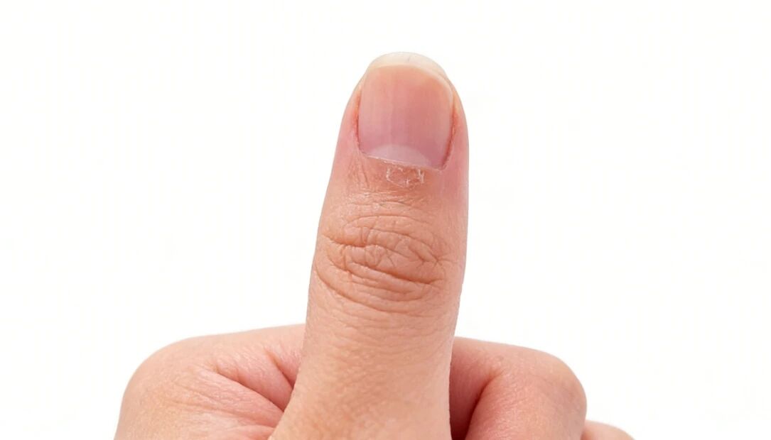 手指长倒刺，是因为缺乏维生素？你相信吗 | 健证方圆